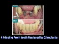 How crowns attach to dental implants ? Front teeth replacement | Dental Implants.