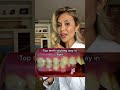 Signs You Need Braces-Excess Overjet