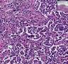 Histopathology Lung--Desquamative interstitial pneumonia