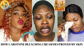 STORYTIME: HOW CAROTONE BLEACHING CREAM DESTROYED MY SKIN😭😭