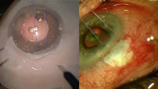 Simulated Surgery: Trabeculectomy: Creating a Scleral Flap