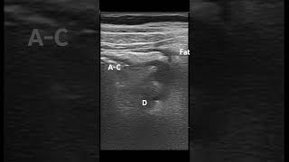 34M, R abdominal pain. POCUS: A-colon diverticulitis #ApacheUltrasound