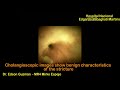 ENDOSCOPIC FEATURES OF THE BENIGN BILIARY STRICTURE IN CHOLANGIOSCOPY