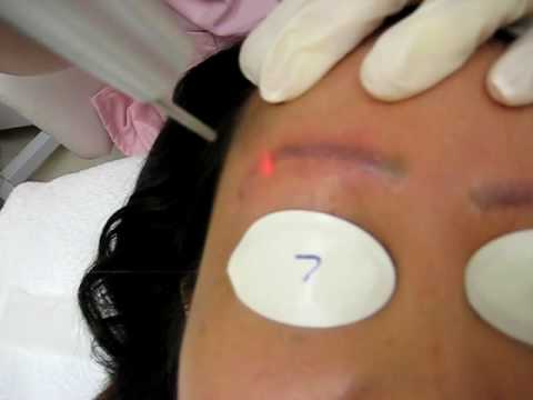 Laser Tattoo Removal Eyebrow Youtube