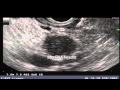 Video 4 EUS FNA of a Pancreatic Mass