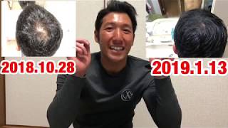 AGA薄毛治療始めて3カ月経過！驚くべき結果が、、、  薄发 Thin hair