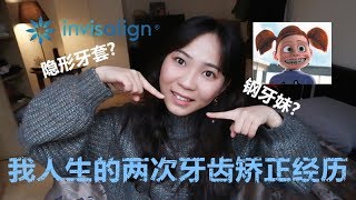 整牙堪比整容|我的两次牙齿矫正经历?|隐形牙套隐适美|选择钢牙套还是隐适美?