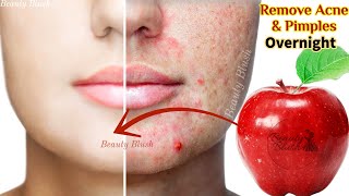 How To Remove Pimples Overnight | Acne Treatment | Remove Acne Pimples Fast Simple \u0026 Effective