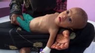 Yemeni babies haunted by hunger, malnutrition