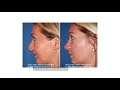 Removing a Bulbous Tip - Nose Surgery and Recovery