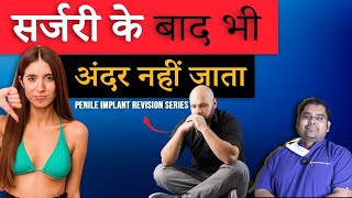 ढीले से Tight | Penile Implant Revision (Loose Hinge)