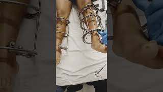 Height Increase Surgery | Surgery For Height | Limb Lengthening Surgery In Delhi