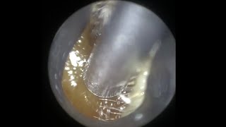 107 - Removal of Ear Wax from Fellow Audiologist using WAXscope®️