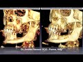 boxtechnique in severe mandibular atrophy of class 5 by cawood and howell classification