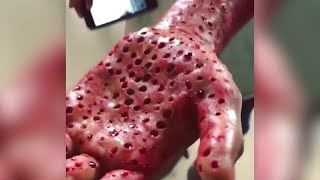 Do You Have Trypophobia: The Fear of Holes? | The Doctors