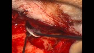 Tympanoplasty with canal wall reconstruction for old radicalized cavities 2