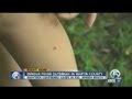 Dengue fever outbreak in Martin County