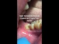 wisdom tooth extraction