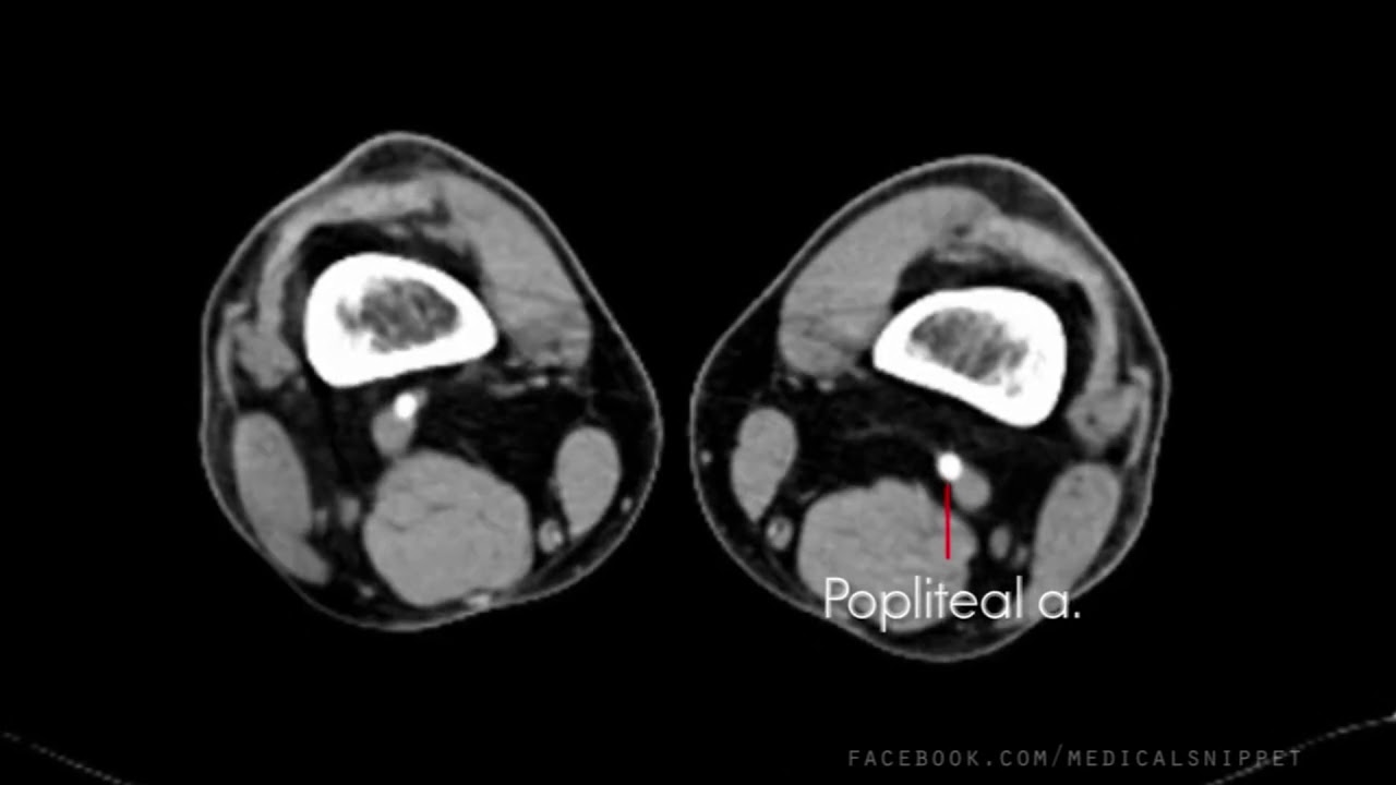 Lower Limb Arterial Anatomy Ct Scan Youtube Lower Limb Arterial Anatomy Ct Scan Youtube