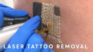 Laser Tattoo Removal: PAIN, RESULTS \u0026 PROCEDURE