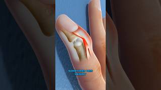 What is mallet finger? (3D Animation)