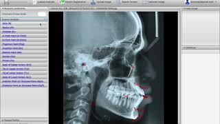 AutoCEPH- Web Service for Computerized Cephalometric Analysis