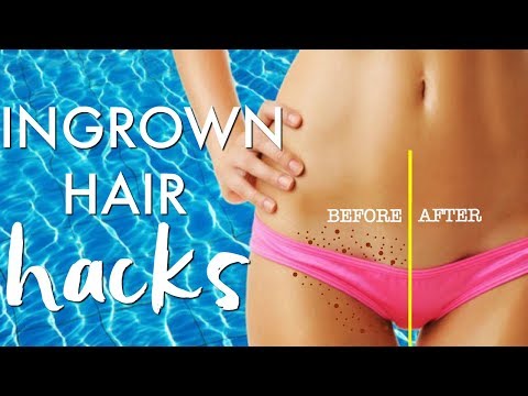 INGROWN HAIR HACKS | GET RID of INGROWN HAIRS | Paris & Roxy INGROWN HAIR HACKS | GET RID of INGROWN HAIRS | Paris & Roxy