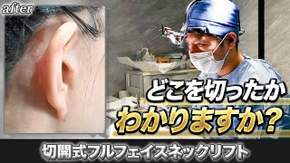 【たるみ解消】傷跡が究極に目立たないフェイスリフトの手術を全公開！