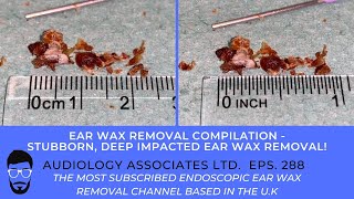 STUBBORN, DEEP EAR WAX REMOVAL - EP288