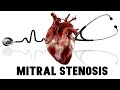 Mitral stenosis explained in detail || Clinical findings || Auscultatory findings