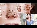 ASMR Treatment Blackhead removal collection and treatment to remove secretions caused at nose