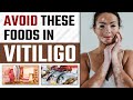 Avoid These Foods in Vitiligo | Best Diet Plan for Vitiligo Patients | Non Veg in Vitiligo