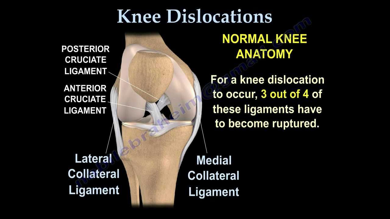 Knee Dislocations - Everything You Need To Know - Dr. Nabil Ebraheim ...