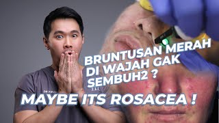 WAJAH MERAH BRUNTUSAN GAK SEMBUH-SEMBUH? MUNGKIN KAMU ADA ROSACEA!