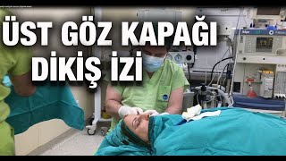 Üst Göz Kapağı Dikiş İzi