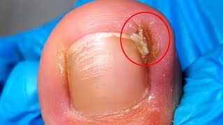 There Are Sharp Corners At The Front Of The Toenails And They Are Inflamed