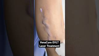 Using a laser to zap varicose veins (3D Animation)