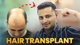 From Bald to Bold: Grade 7 Baldness Conquered 😲 | Hair Transplant Nagpur | New Roots