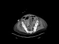 Sigmoid anastomotic dehiscence