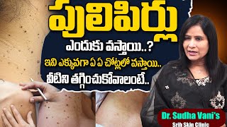 How to Get Rid of Warts | Best Treatment for Skin Tag's | Dr. Sudha Vani | SumanTv