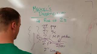 Meckel's Diverticulum: The Rule of 2's!