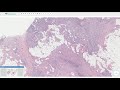 Fibrous Hamartoma of Infancy - Histopathology