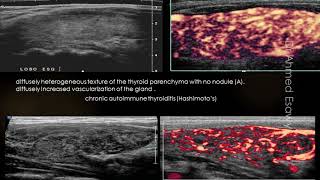 Thyroid Ultrasound All things you should know (video book)