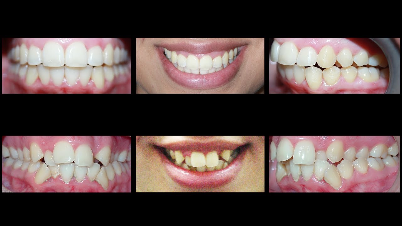 Invisalign For Treating Crowding Teeth And Crossbite At Cosmetic Dental