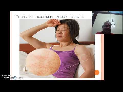 Dengue fever prevention treatment cause symptoms by dr surya prakash (DPh) Dengue fever prevention treatment cause symptoms by dr surya prakash (DPh)