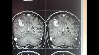 TRANS SULCAL APPROACH FOR MICRONEUROSURGICAL EXCISION OF RIGHT MOTOR CORTEX CAVERNOMA