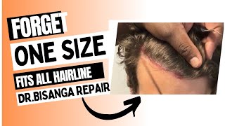 HAIRLINE DESIGN: Avoid These Common Errors Hair Line Designs #fuehairtransplant  #fuesurgery