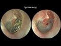 foreign body in the ear 귀에서 벌레가