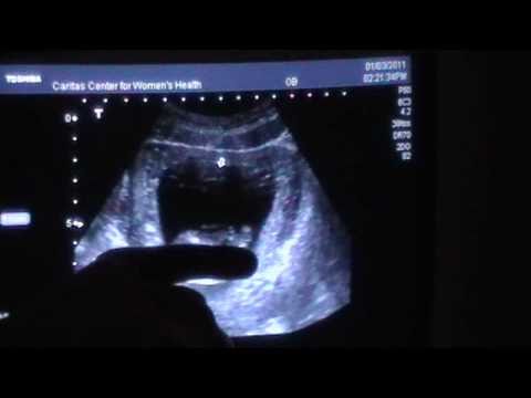 My 12 Week Ultrasound..It's a..... My 12 Week Ultrasound..It's a.....