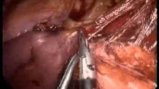 Laparoscopic Oncologic Low Anterior Resection of the Rectum